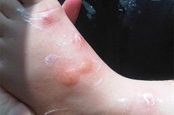 Клопы покусали ногу ребенка Клопы покусали ногу
