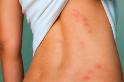 Так выглядят укусы постельных клопов Укусы постельных клопов